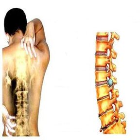 Štádiá osteochondrózy