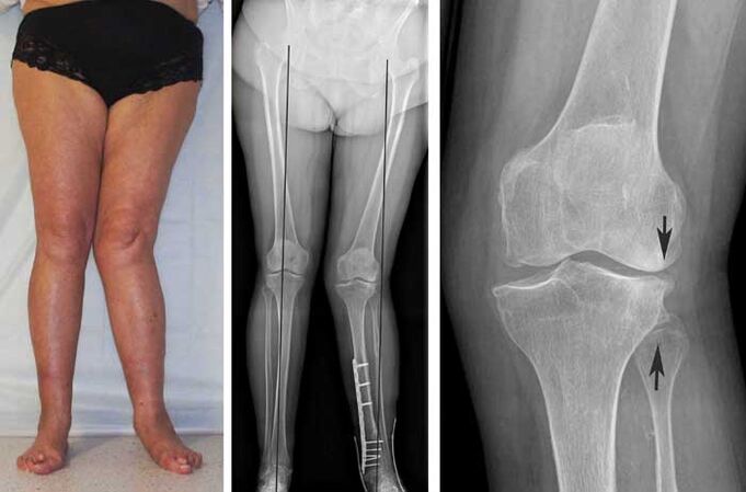pokročilá artróza kolenného kĺbu