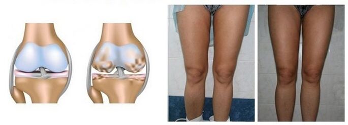 porážka artrózy kolenného kĺbu s artrózou