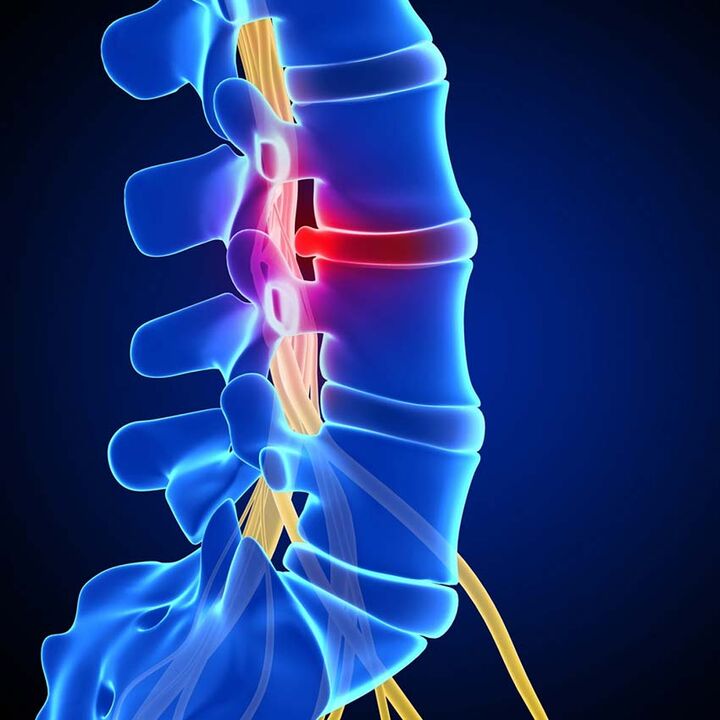 Vyčnievanie medzistavcového disku do miechového kanála v dôsledku osteochondrózy bedrovej chrbtice