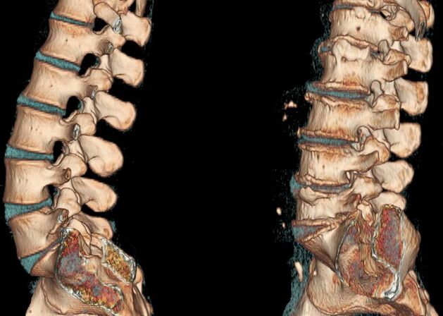 Osteochondróza chrbtice na CT vyšetrení